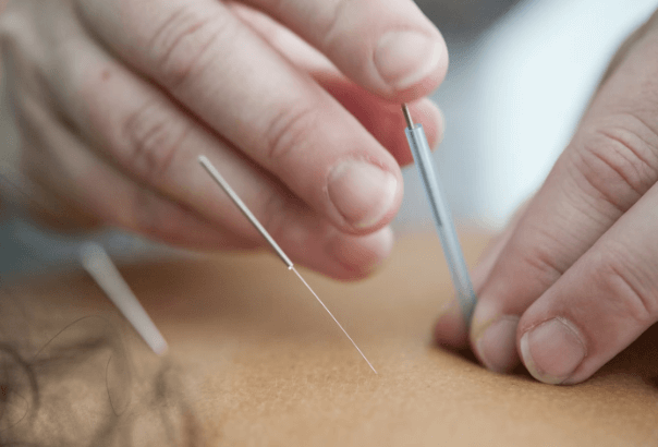 Acupuncture Services for Natural Healing and Pain Relief